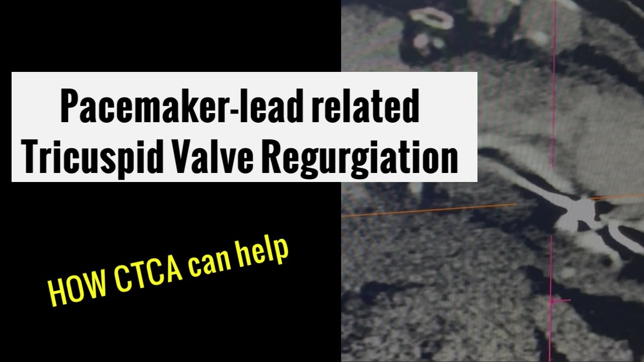 Cardiac CT coronary angiogram and pacemaker lead-related tricuspid valve regurgitation
