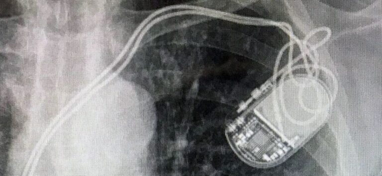 Pacemaker-induced Tricuspid Regurgitation (CIED-related TR)
