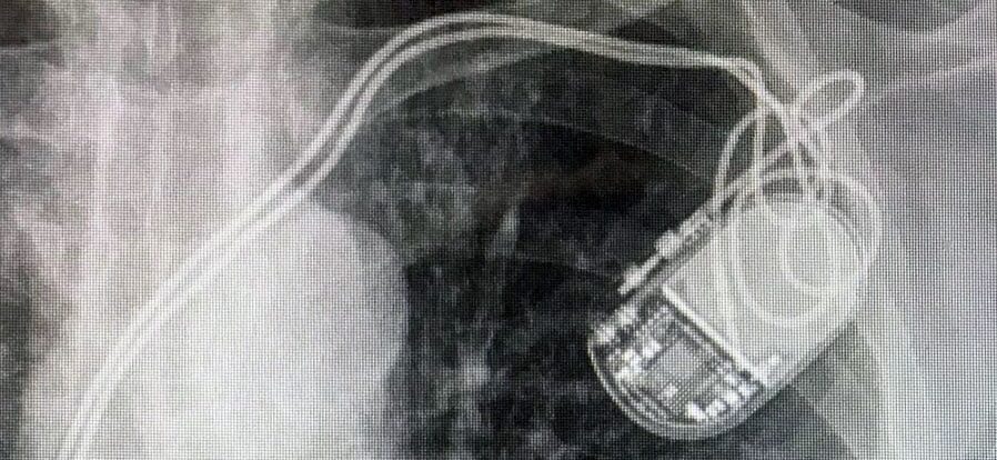Pacemaker-induced Tricuspid Regurgitation (CIED-related TR)