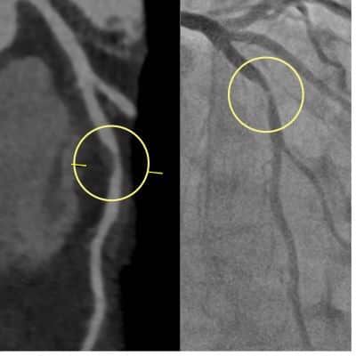 Calcium score 0 with severe CAD