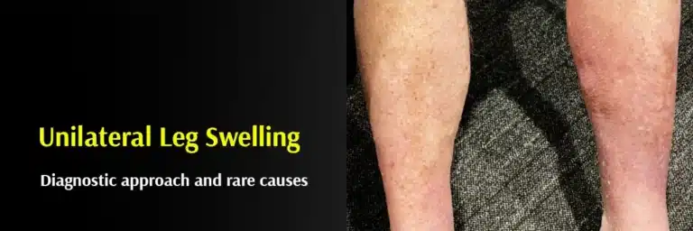 Unilateral Leg Swelling and Post-Thrombotic-Syndrome