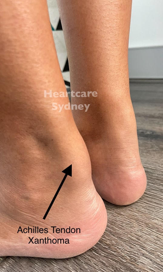 Achilles Tendon Xanthoma Achilles Tendon Xanthoma