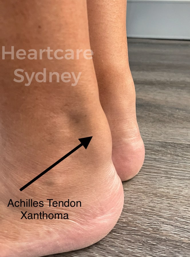 Achilles Tendon Xanthoma Achilles Tendon Xanthoma