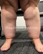 lipedema-diagnosis-and-management